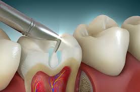 Dental Fillings