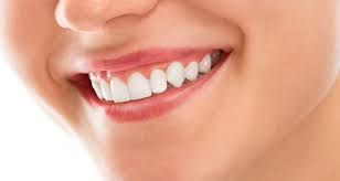 Smile Makeover